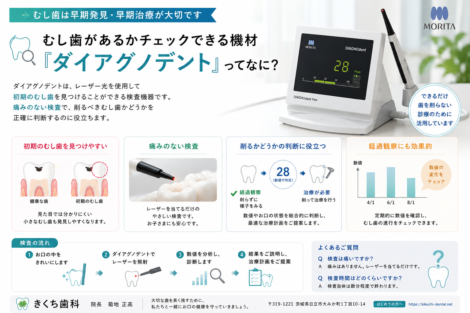ダイアグノデントとは？レーザーで初期むし歯をチェックする検査機器を